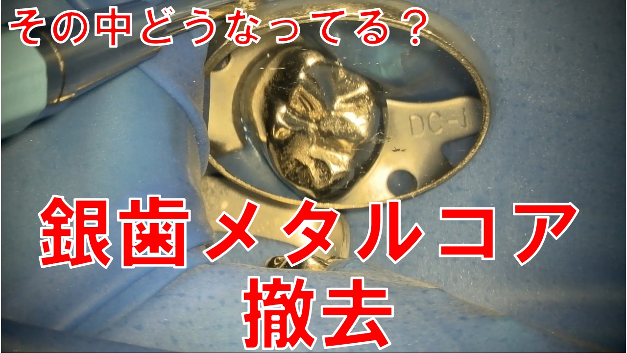 メタルコア　銀歯　外す　名医　自由が丘　歯医者　デンタルアトリエ