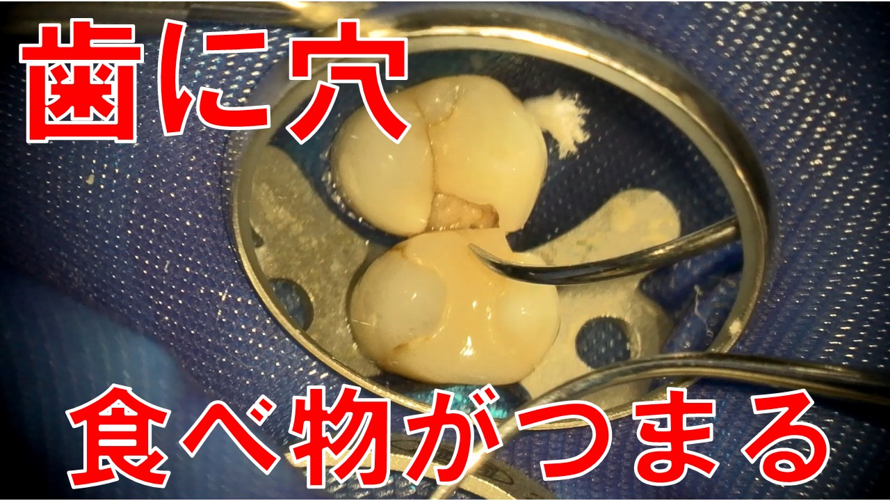 歯に穴　食べ物がつまる　虫歯　根管治療　神経温存療法　歯医者　自由が丘