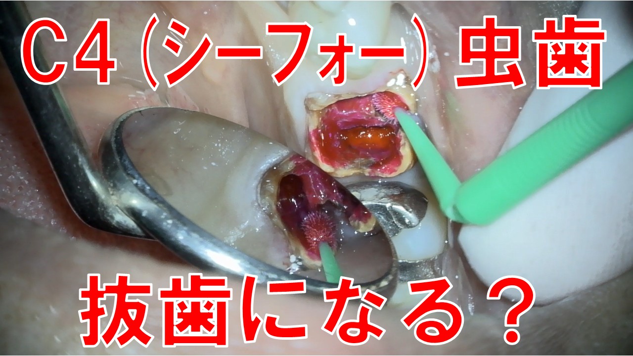C4　虫歯　虫歯治療 抜歯　歯を残す　自由が丘　歯医者　デンタルアトリエ