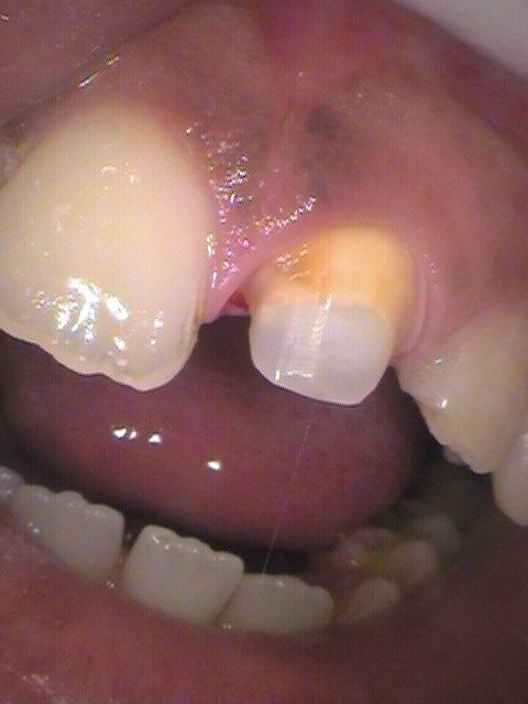 ファイバーコア形成