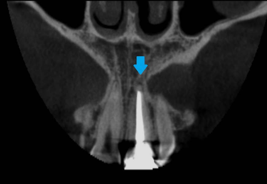 レジン前装冠CT画像