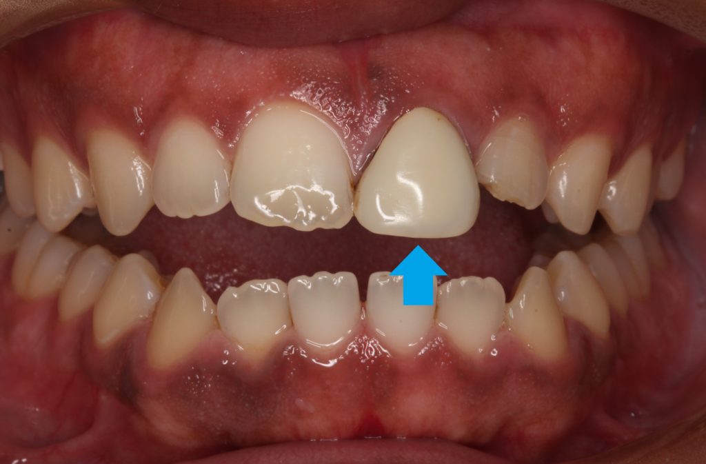 保険のレジン前装冠