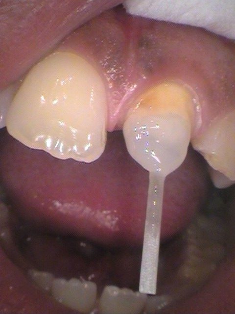 ファイバーコア