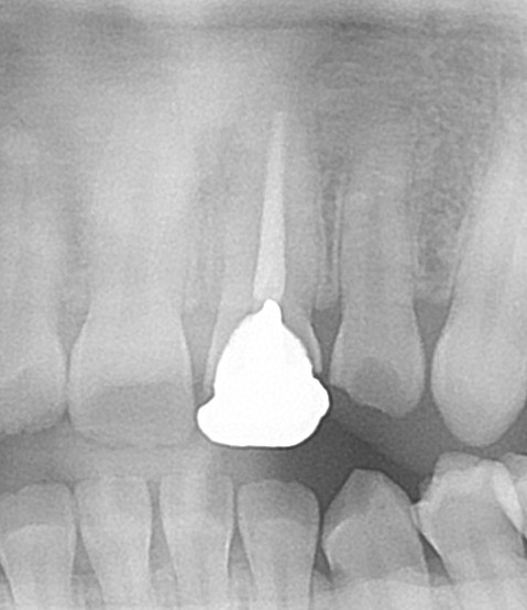 レジン前装冠レントゲン