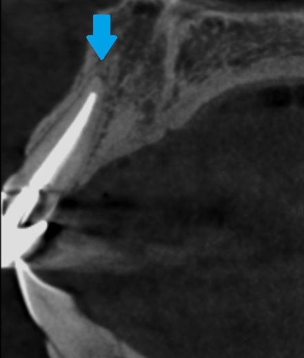 レジン前装冠CT画像