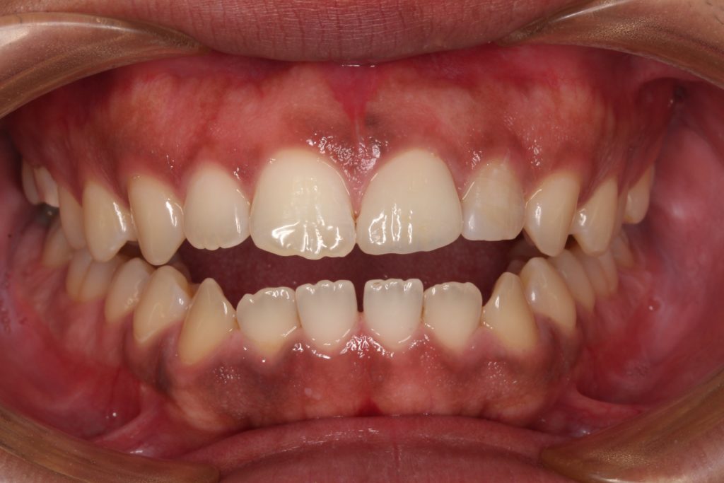 ジルコニアセラミッククラウン