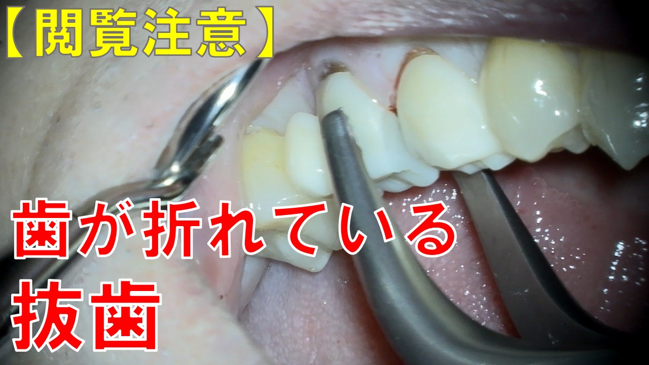 歯根破折　抜歯　歯医者　自由が丘　デンタルアトリエ　歯が割れた