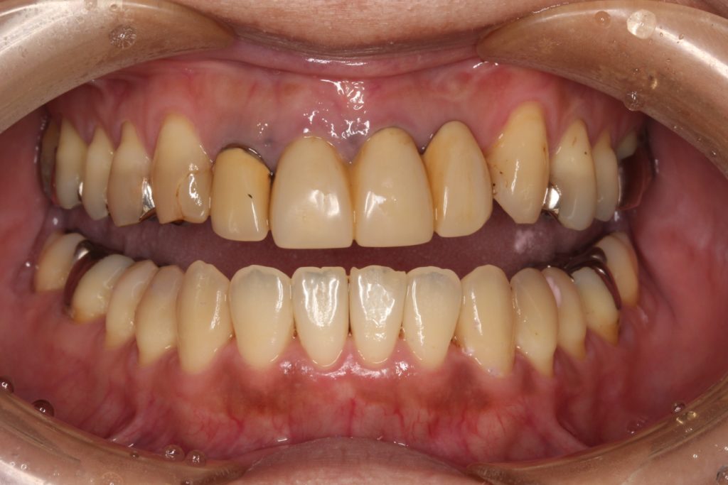 前歯 かぶせ物 クラウン 色が合っていない 形が合っていない セラミック ジルコニア 審美歯科 自由が丘 世田谷 目黒 歯医者 東京