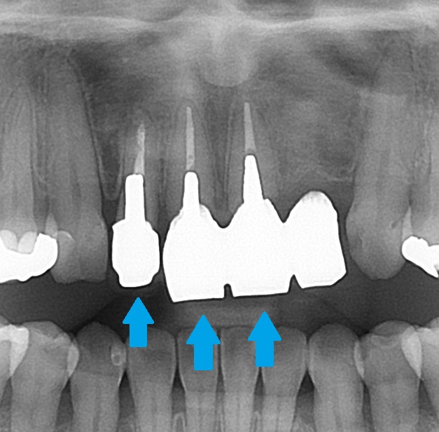 前歯 かぶせ物 クラウン 色が合っていない 形が合っていない セラミック ジルコニア 審美歯科 自由が丘 世田谷 目黒 歯医者 東京