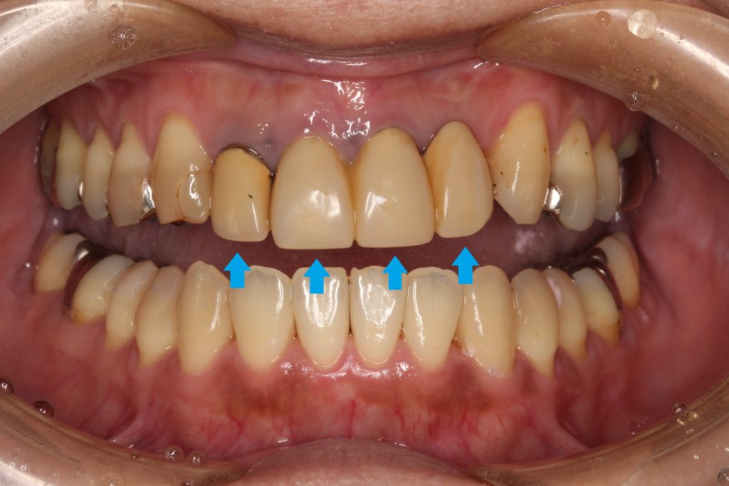 前歯 かぶせ物 クラウン 色が合っていない 形が合っていない セラミック ジルコニア 審美歯科 自由が丘 世田谷 目黒 歯医者 東京