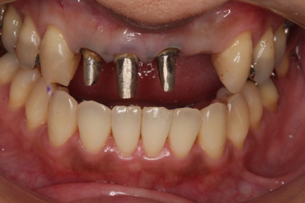 前歯 かぶせ物 クラウン 色が合っていない 形が合っていない セラミック ジルコニア 審美歯科 自由が丘 世田谷 目黒 歯医者 東京