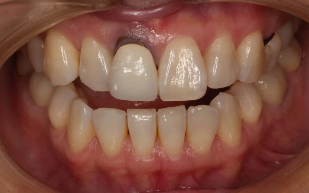 黒い差し歯BEFORE