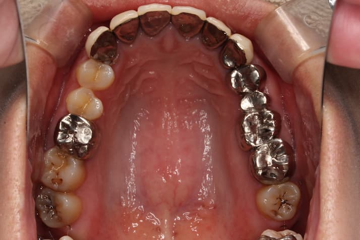 全顎治療　フルマウス　症例　経過　良好　虫歯全部治す　インプラント