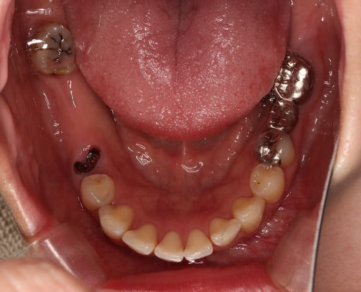 全顎治療　フルマウス　症例　経過　良好　虫歯全部治す　インプラント