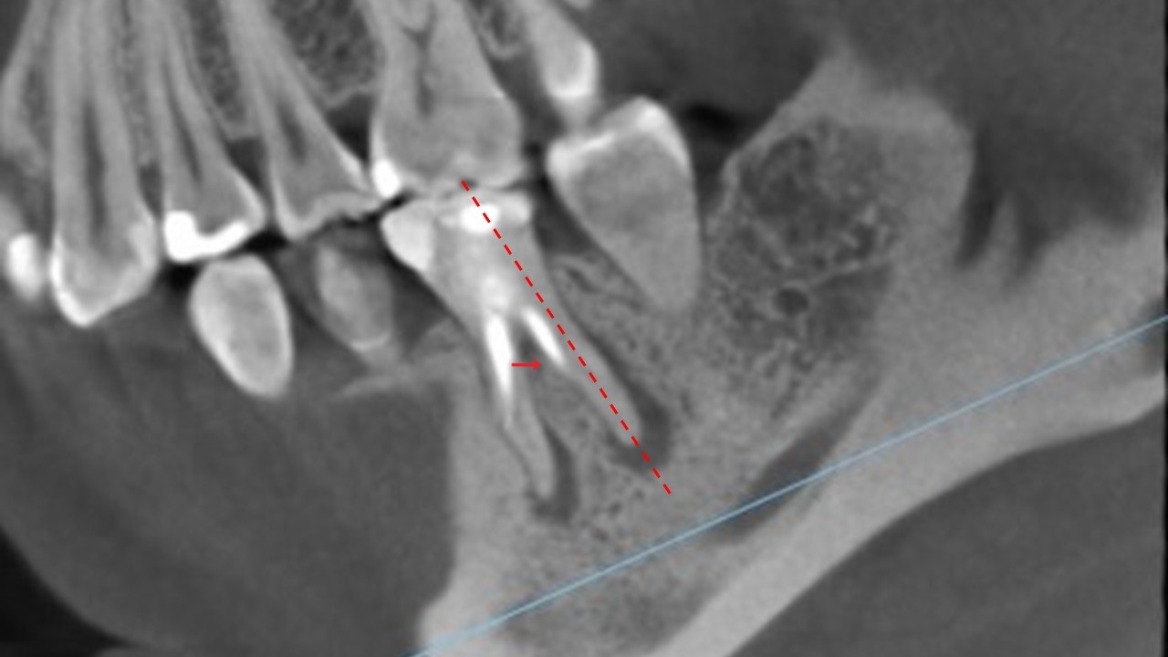 根管治療　根幹治療　穿孔　パーフォレーション　再根管治療　術後　治癒
