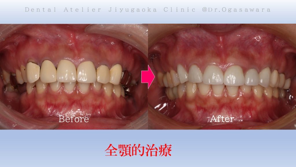 全顎治療　フルマウス　症例　経過　良好　虫歯全部治す　インプラント