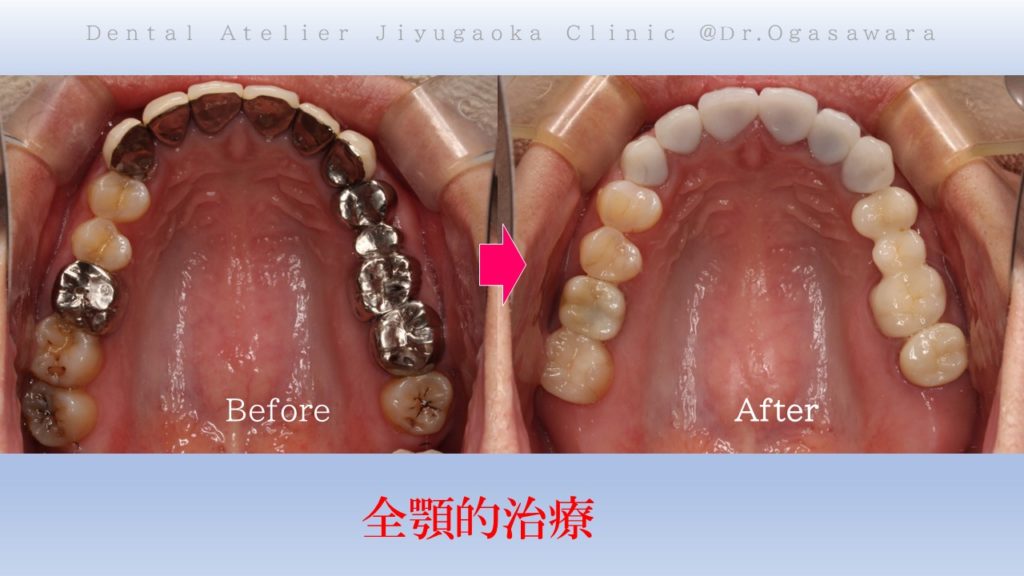 全顎治療　フルマウス　症例　経過　良好　虫歯全部治す　インプラント
