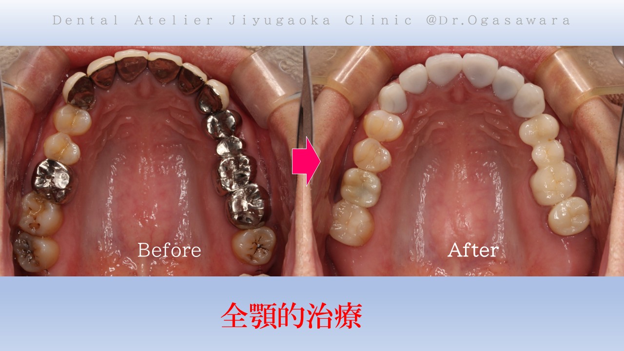 全顎治療　フルマウス　症例　経過　良好　虫歯全部治す　インプラント