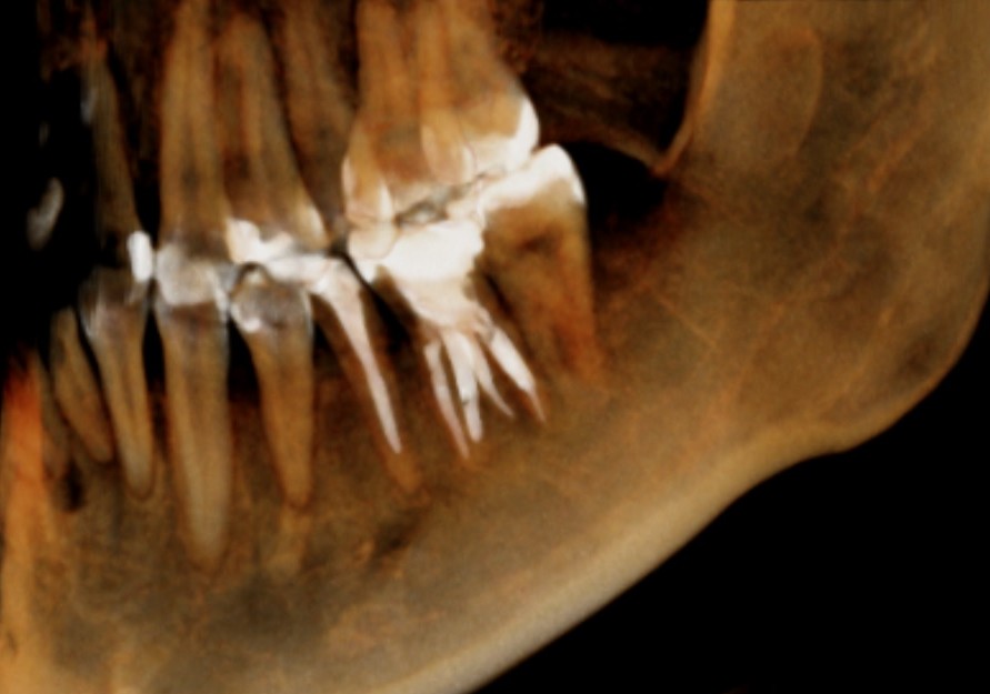 根管治療　根幹治療　穿孔　パーフォレーション　再根管治療　術後　治癒