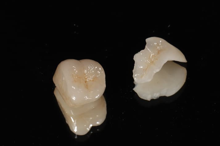 インレー 寿命 セラミック ジルコニア どのくらい持つ