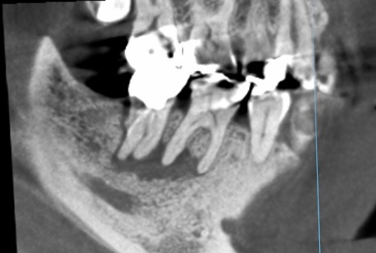根管治療　再根管治療　マイクロスコープ　溶けた骨　顎の骨が溶けた　骨が再生