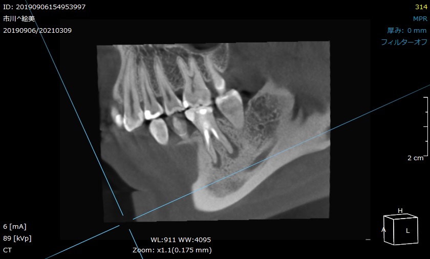 根管治療　根幹治療　穿孔　パーフォレーション　再根管治療　術後　治癒