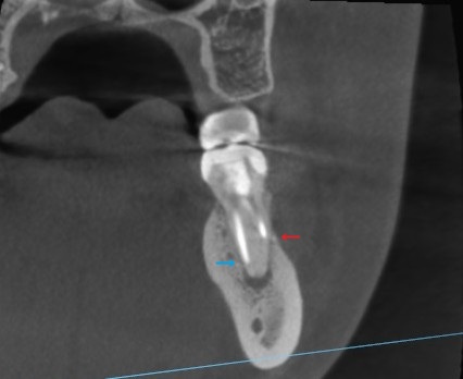 根管治療　根幹治療　穿孔　パーフォレーション　再根管治療　術後　治癒