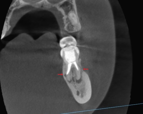 根管治療　根幹治療　穿孔　パーフォレーション　再根管治療　術後　治癒