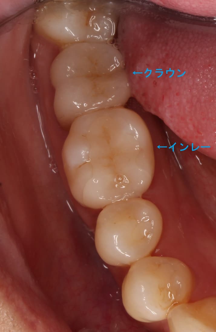 インレー 寿命 セラミック ジルコニア どのくらい持つ