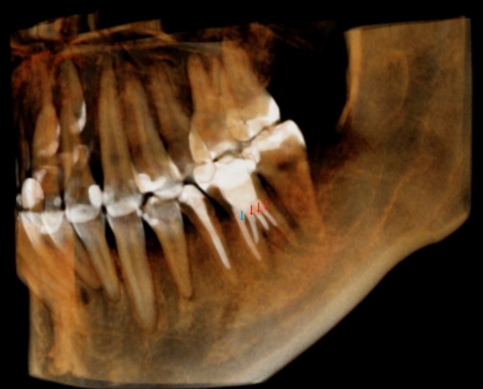 根管治療　根幹治療　穿孔　パーフォレーション　再根管治療　術後　治癒
