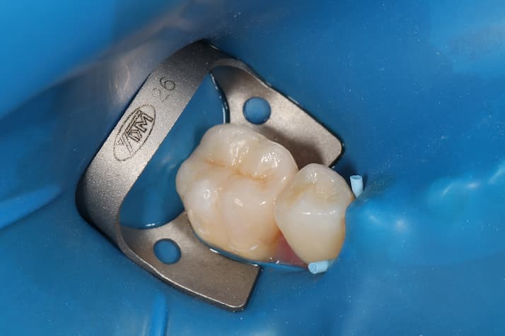 インレー 寿命 セラミック ジルコニア どのくらい持つ