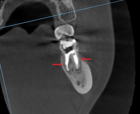 根管治療　根幹治療　穿孔　パーフォレーション　再根管治療　術後　治癒