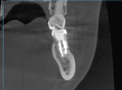 根管治療　根幹治療　穿孔　パーフォレーション　再根管治療　術後　治癒