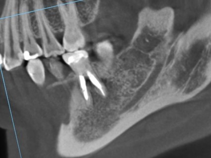 根管治療　根幹治療　穿孔　パーフォレーション　再根管治療　術後　治癒